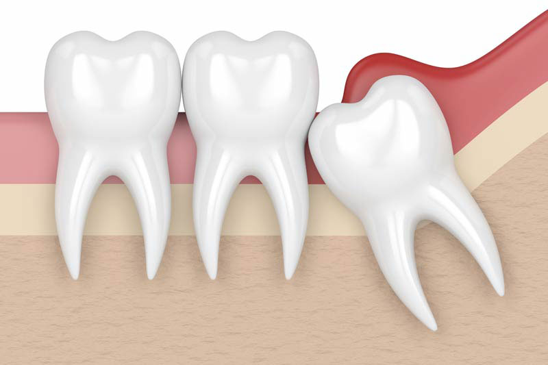 Teeth Whitening in Chicago